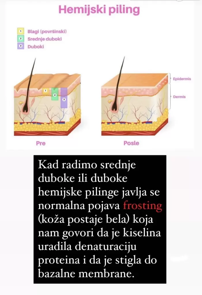 Hemijski piling metoda