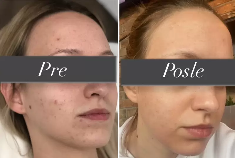 Higijenski tretman lica čišćenja kože pročišćavanje pora