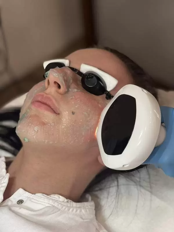 Laserski tretman kože Lumecca laser bezbolno rešenje