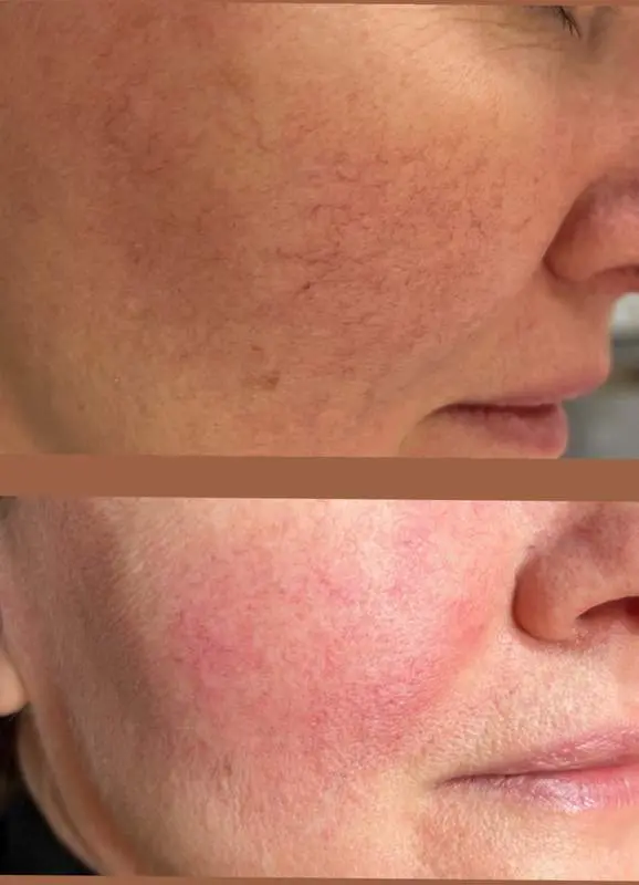 lasersko uklanjanje kapilara