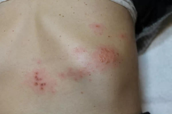 Herpes ZOSTER? Kako ga prepoznati