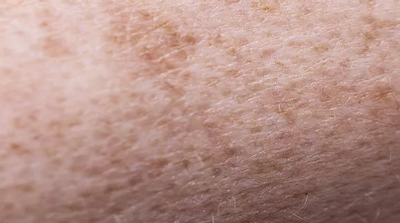 Hiperpigmentacija fleke tamne mrlje na koži različitog oblika