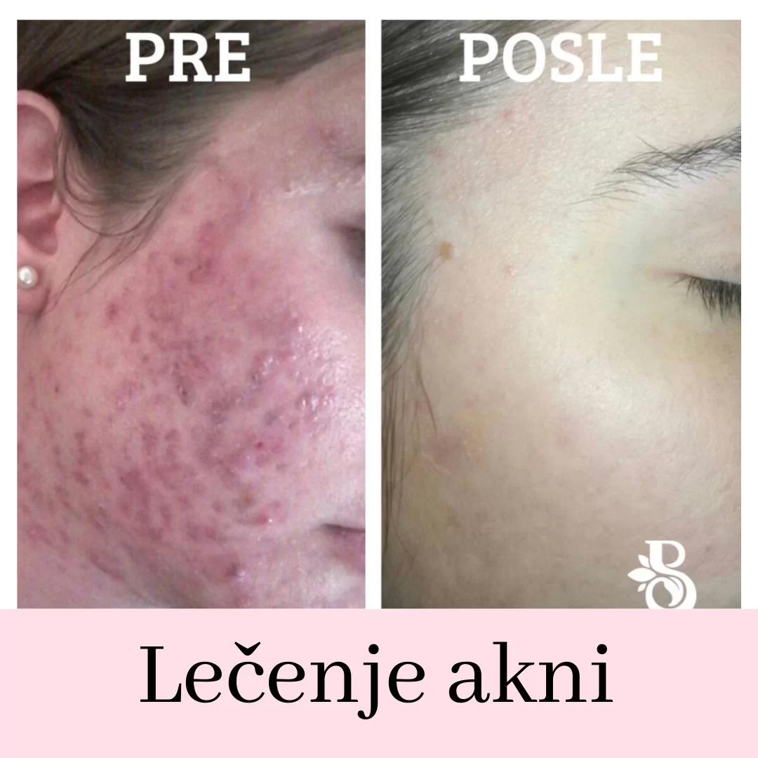 Dermatološki Pregledi Kože Lečenje Akni